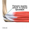 tennis elbow
